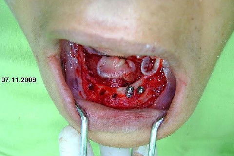 Protocolo Inferior com 5 Implantes - Parte I - Planejamento + Cirurgia