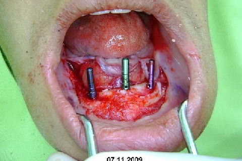 Protocolo Inferior com 5 Implantes - Parte I - Planejamento + Cirurgia