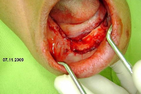 Protocolo Inferior com 5 Implantes - Parte I - Planejamento + Cirurgia