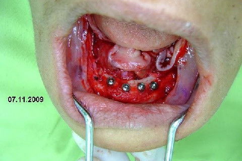 Protocolo Inferior com 5 Implantes - Parte I - Planejamento + Cirurgia