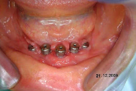 Protocolo Inferior com 5 Implantes - Parte I - Planejamento + Cirurgia