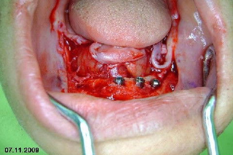 Protocolo Inferior com 5 Implantes - Parte I - Planejamento + Cirurgia