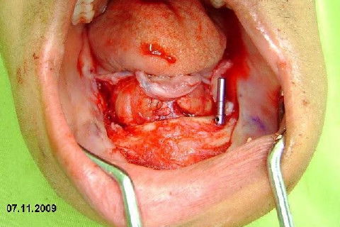 Protocolo Inferior com 5 Implantes - Parte I - Planejamento + Cirurgia