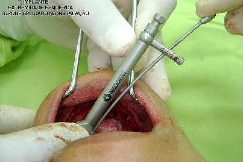 Protocolo Inferior com 5 Implantes - Parte I - Planejamento + Cirurgia