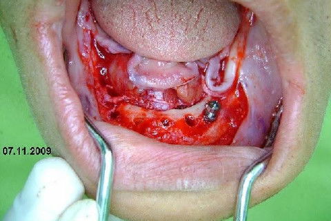 Protocolo Inferior com 5 Implantes - Parte I - Planejamento + Cirurgia
