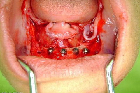 Protocolo Inferior com 5 Implantes - Parte I - Planejamento + Cirurgia