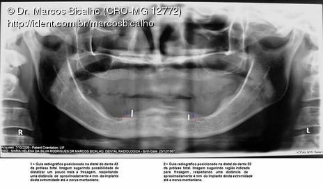 Guia radiográfico para localização do forame mentoniano. Um recurso eficiente. Adaptamos um clip (colamos na PT inferior, região dos caninos para servir como guia) e localizamos o forame mentoniano para planejar a distância horizontal entre os implantes, calcular e confirmar o espaço disponível para 5 implantes.