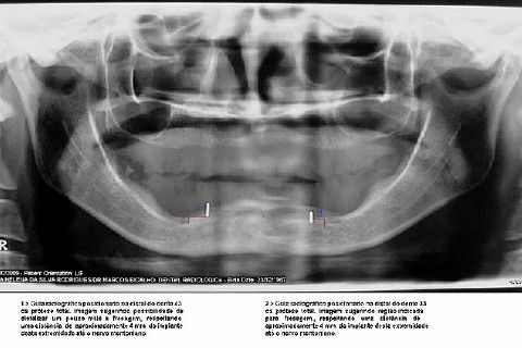 Guia radiográfico para localização do forame mentoniano. Um recurso eficiente. Adaptamos um clip (colamos na PT inferior, região dos caninos para servir como guia) e localizamos o forame mentoniano para planejar a distância horizontal entre os implantes, calcular e confirmar o espaço disponível para 5 implantes.