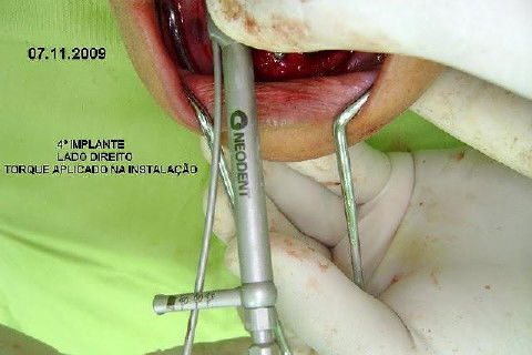 Protocolo Inferior com 5 Implantes - Parte I - Planejamento + Cirurgia