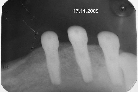 Protocolo Inferior com 5 Implantes - Parte I - Planejamento + Cirurgia