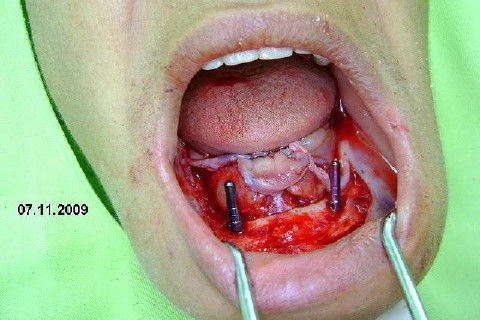 Protocolo Inferior com 5 Implantes - Parte I - Planejamento + Cirurgia