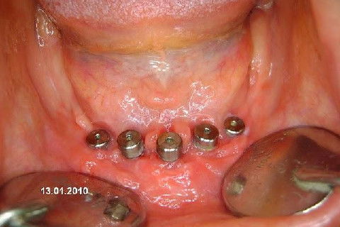 Mucosa cicatrizada, pronto para moldagem.