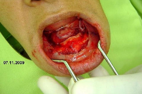 Protocolo Inferior com 5 Implantes - Parte I - Planejamento + Cirurgia