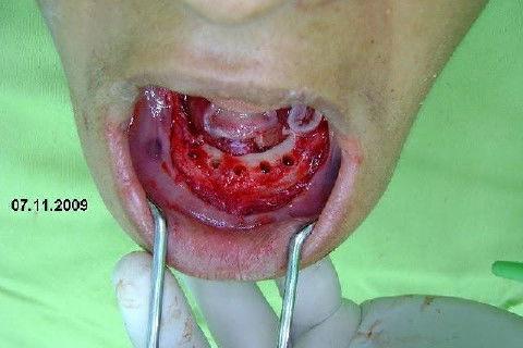 Protocolo Inferior com 5 Implantes - Parte I - Planejamento + Cirurgia