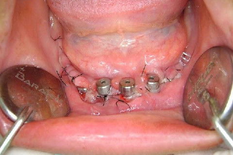 Protocolo Inferior com 5 Implantes - Parte I - Planejamento + Cirurgia