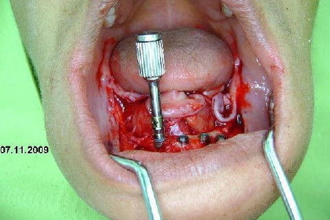 Protocolo Inferior com 5 Implantes - Parte I - Planejamento + Cirurgia