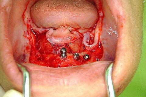Protocolo Inferior com 5 Implantes - Parte I - Planejamento + Cirurgia