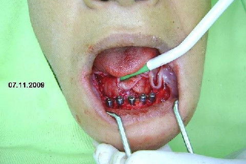 Protocolo Inferior com 5 Implantes - Parte I - Planejamento + Cirurgia