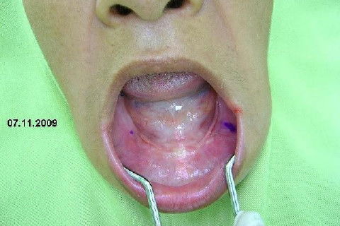 Protocolo Inferior com 5 Implantes - Parte I - Planejamento + Cirurgia