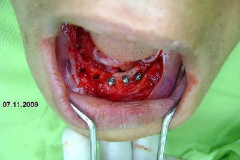 Protocolo Inferior com 5 Implantes - Parte I - Planejamento + Cirurgia