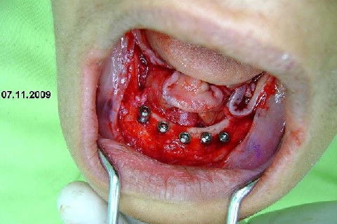 Protocolo Inferior com 5 Implantes - Parte I - Planejamento + Cirurgia