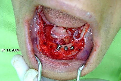 Protocolo Inferior com 5 Implantes - Parte I - Planejamento + Cirurgia