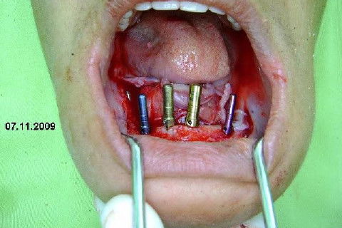 Protocolo Inferior com 5 Implantes - Parte I - Planejamento + Cirurgia
