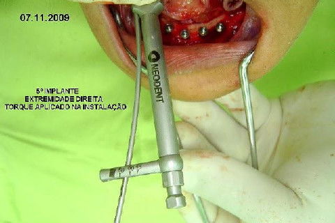 Protocolo Inferior com 5 Implantes - Parte I - Planejamento + Cirurgia