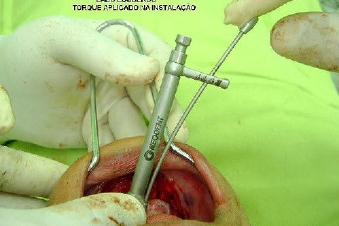 Protocolo Inferior com 5 Implantes - Parte I - Planejamento + Cirurgia