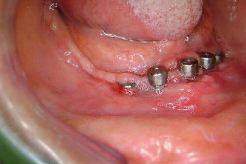 Protocolo Inferior com 5 Implantes - Parte I - Planejamento + Cirurgia