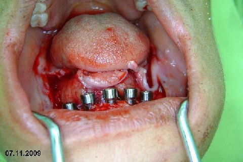 Após a isntalação dos implantes, opttamos pela instalação imediata dos cicatrizadores, considerando o torque adequado em todos os implantes.