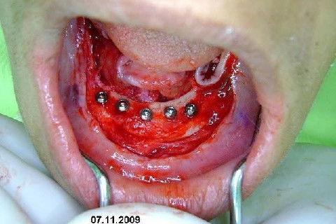 Protocolo Inferior com 5 Implantes - Parte I - Planejamento + Cirurgia