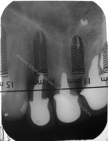 Seleção do implante pela régua da Neodent sobre a ragiografia periapical