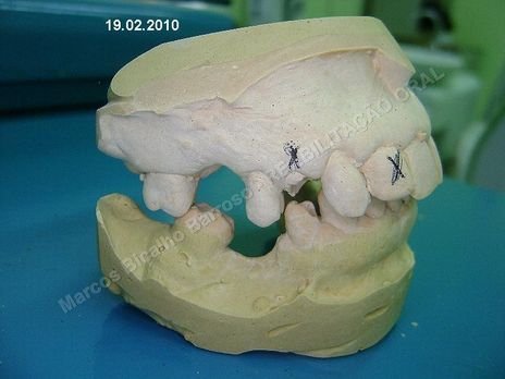 Reabilitação Oral - Parte I - Implantes Dentários e Cirurgias Pré Implantodônticas