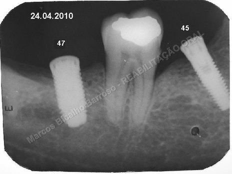 Reabilitação Oral - Parte Ii - Implantes Dentários e Cirurgias Pré Implantodônticas