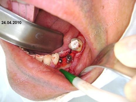 Reabilitação Oral - Parte Ii - Implantes Dentários e Cirurgias Pré Implantodônticas