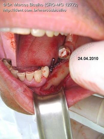 Reabilitação Oral - Parte Ii - Implantes Dentários e Cirurgias Pré Implantodônticas