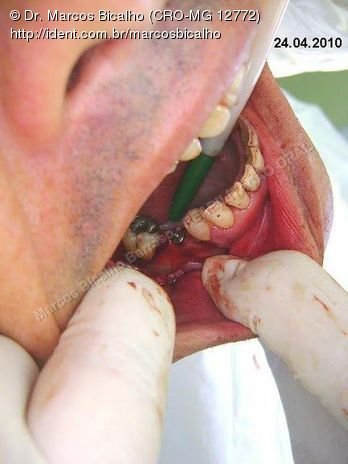 Reabilitação Oral - Parte Ii - Implantes Dentários e Cirurgias Pré Implantodônticas