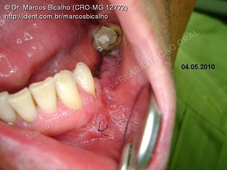 Reabilitação Oral - Parte Ii - Implantes Dentários e Cirurgias Pré Implantodônticas