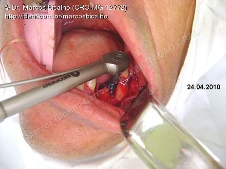 Reabilitação Oral - Parte Ii - Implantes Dentários e Cirurgias Pré Implantodônticas