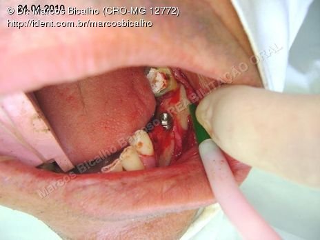 Reabilitação Oral - Parte Ii - Implantes Dentários e Cirurgias Pré Implantodônticas