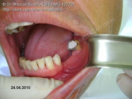 Reabilitação Oral - Parte Ii - Implantes Dentários e Cirurgias Pré Implantodônticas