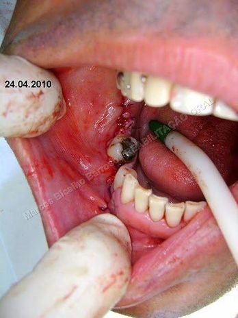 Reabilitação Oral - Parte Ii - Implantes Dentários e Cirurgias Pré Implantodônticas