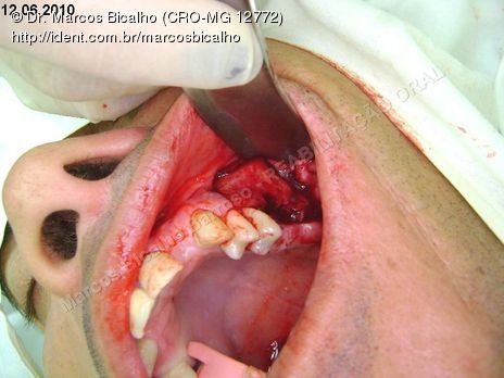 Reabilitação Oral - Parte Iii - Implantes Dentários e Cirurgias Pré Implantodônticas