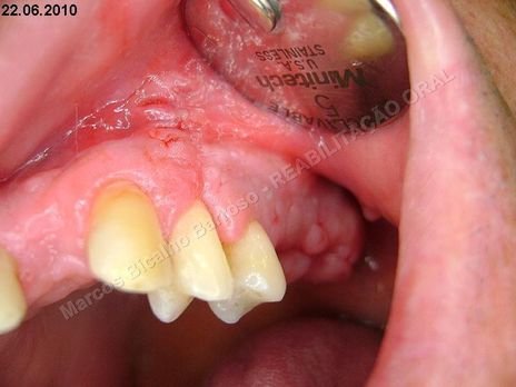 Reabilitação Oral - Parte Iii - Implantes Dentários e Cirurgias Pré Implantodônticas