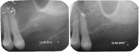 Reabilitação Oral - Parte Iii - Implantes Dentários e Cirurgias Pré Implantodônticas