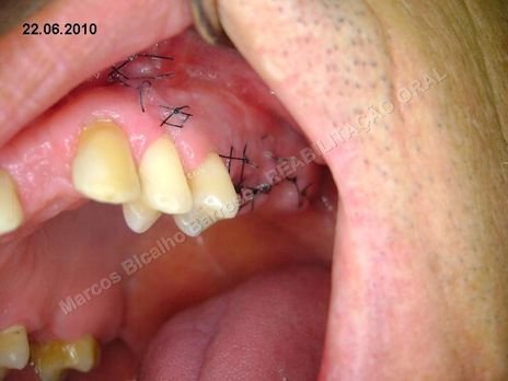 Reabilitação Oral - Parte Iii - Implantes Dentários e Cirurgias Pré Implantodônticas