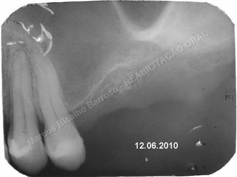 Reabilitação Oral - Parte Iii - Implantes Dentários e Cirurgias Pré Implantodônticas