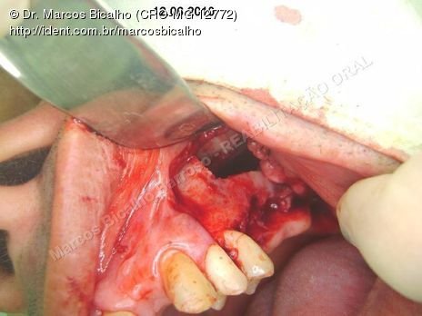 Reabilitação Oral - Parte Iii - Implantes Dentários e Cirurgias Pré Implantodônticas