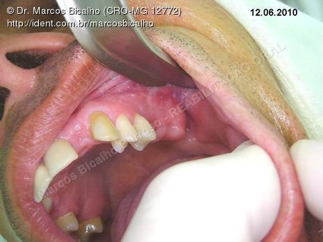 Reabilitação Oral - Parte Iii - Implantes Dentários e Cirurgias Pré Implantodônticas